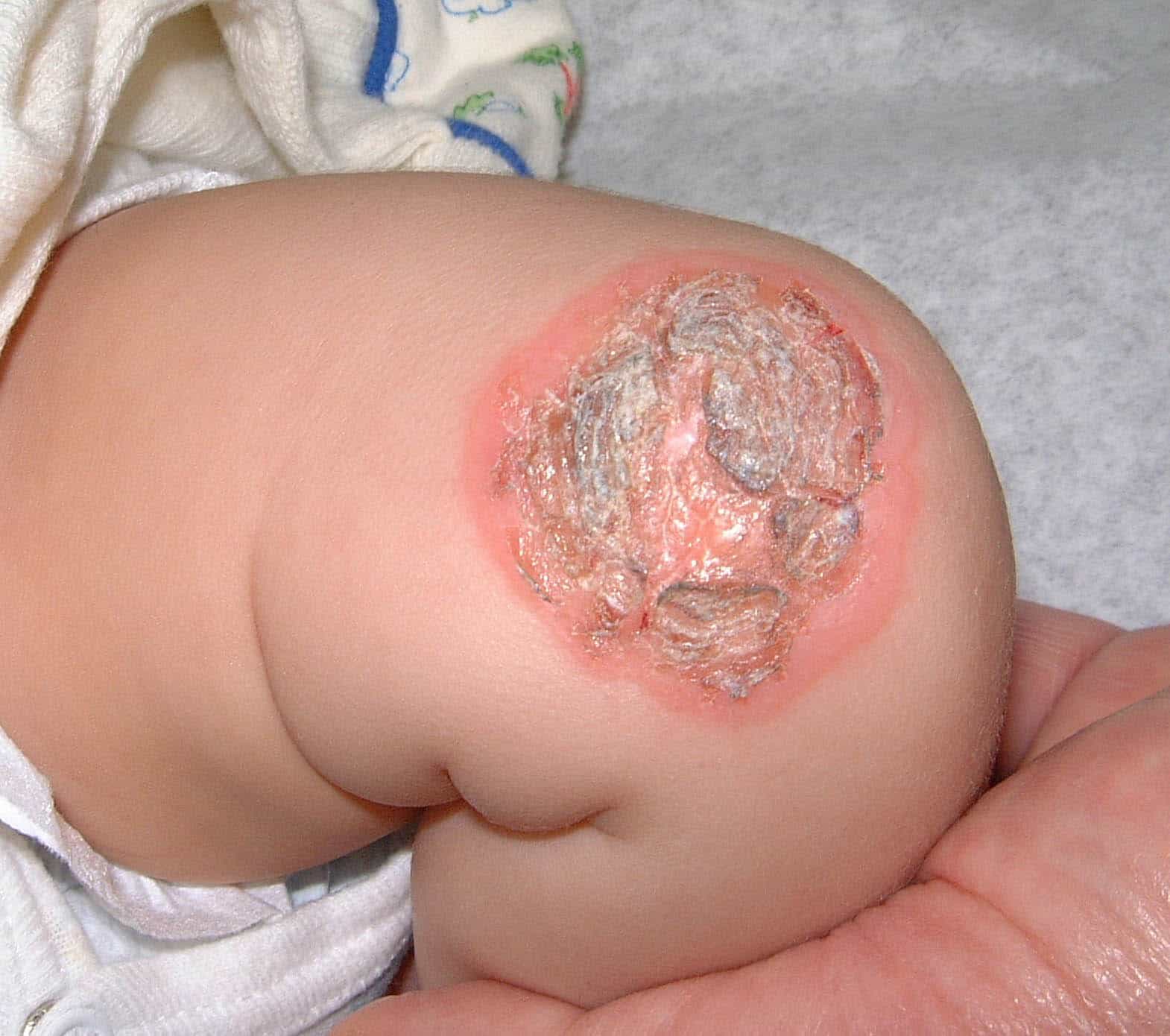 impetigo contagioso