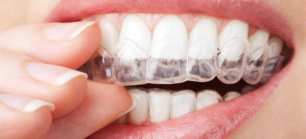 Ortodoncia para mejorar nuestra salud