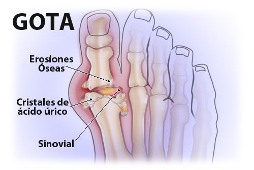 ¿Cómo se debe tratar la gota?