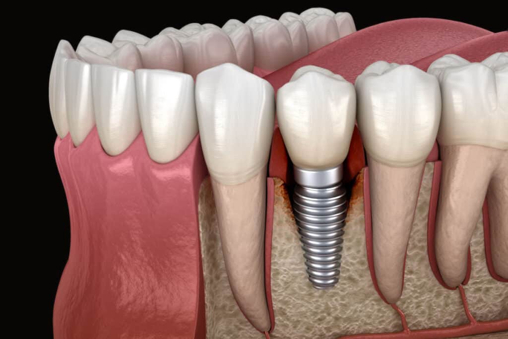 Estas son las enfermedades periimplantarias