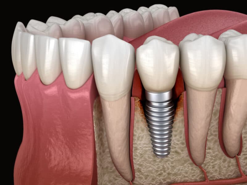 Estas son las enfermedades periimplantarias